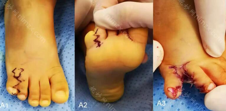 并指其实就是脚趾头连在一起,或者是重复生长出六个指头的畸形.