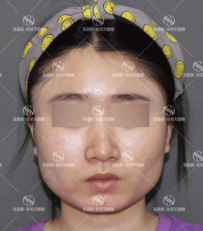国字脸做下颌角截骨整形手术前后效果对比图