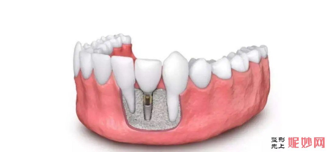 成都种植牙常用这几款植体，哪些好医院都有在用，均价仅需10000元!